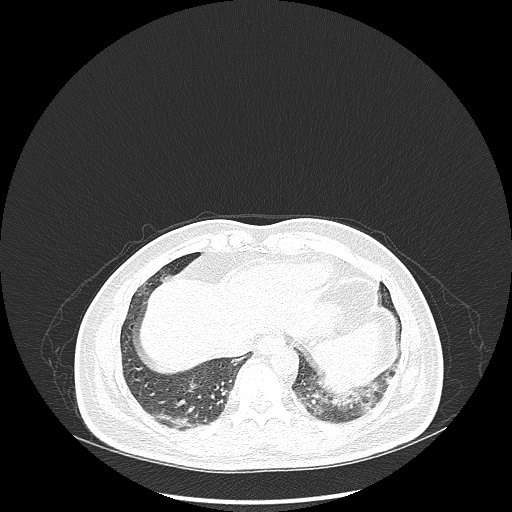 File:Acute appendicitis and COVID 19 pneumonia (Radiopaedia 76604-88380 Axial lung window 45).jpg
