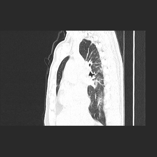 Acute appendicitis and COVID 19 pneumonia (Radiopaedia 76604-88380 Sagittal lung window 40).jpg