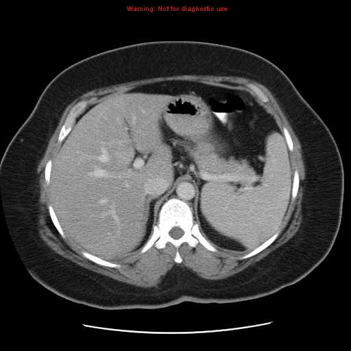 Acute appendicitis complicated by ovarian vein thrombophlebitis (Radiopaedia 16172-15851 Axial C+ portal venous phase 25).jpg