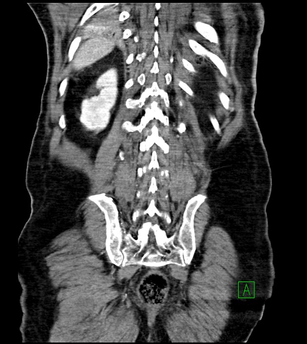 Acute arterial mesenteric ischemia (Radiopaedia 78238-90828 Coronal C+ portal venous phase 75).jpg