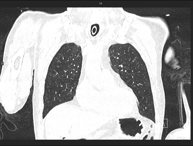 Acute aspiration pneumonitis (Radiopaedia 55642-62166 Coronal lung window 29).jpg