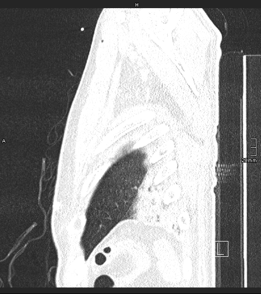 File:Acute aspiration pneumonitis (Radiopaedia 55642-62166 Sagittal lung window 5).jpg