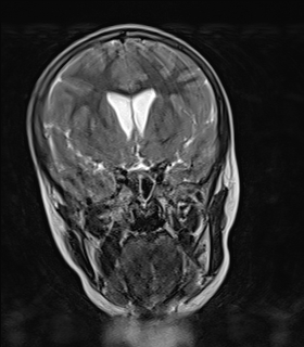 File:Acute cerebellar ataxia (Radiopaedia 61487-69446 Coronal T2 4).jpg