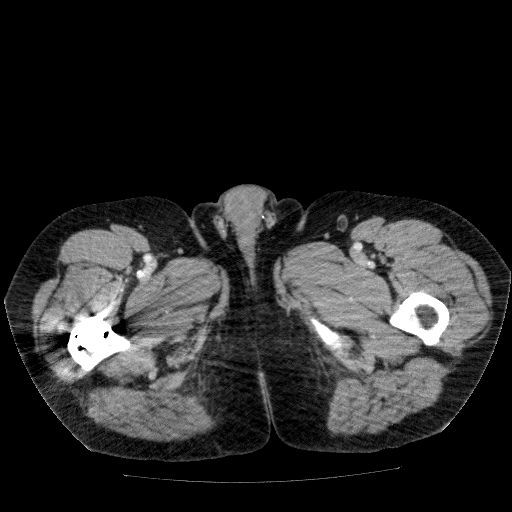 Acute cholecystitis and incidental left sided IVC (Radiopaedia 49352-54459 Axial C+ portal venous phase 176).jpg