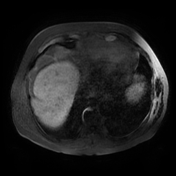 Acute cholecystitis complicated by pylephlebitis (Radiopaedia 65782-74915 Axial T1 fat sat 2).jpg