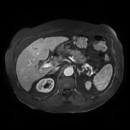 Acute cholecystitis complicated by pylephlebitis (Radiopaedia 65782-74915 Axial arterioportal phase T1 C+ fat sat 53).jpg