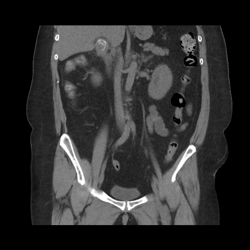 Acute cholecystitis with tensile fundus sign (Radiopaedia 71394-81723 Coronal non-contrast 68).jpg