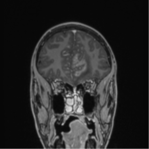 File:Acute disseminated encephalomyelitis (ADEM) (Radiopaedia 65319-74349 Coronal T1 C+ 49).png