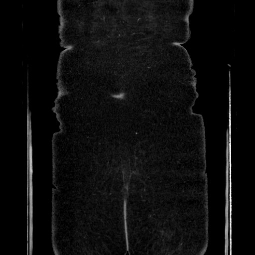 Acute diverticulitis - transverse colon (Radiopaedia 87063-103327 Coronal C+ portal venous phase 156).jpg