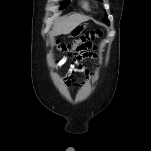 Acute diverticulitis with localized perforation (Radiopaedia 41296-44113 Coronal C+ portal venous phase 15).jpg