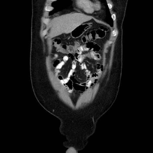 Acute diverticulitis with localized perforation (Radiopaedia 41296-44113 Coronal C+ portal venous phase 16).jpg