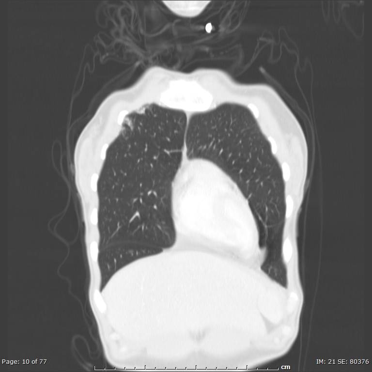 Acute eosinophilic pneumonia (Radiopaedia 48211-53073 Coronal lung window 5).jpg