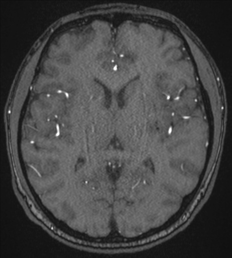 Acute left middle cerebral artery territory infarct with clot retrieval (Radiopaedia 47732-52433 Axial MRA 35).png