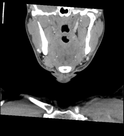 Acute longus colli calcific tendinitis (Radiopaedia 72495-83036 Coronal C+ arterial phase 19).jpg