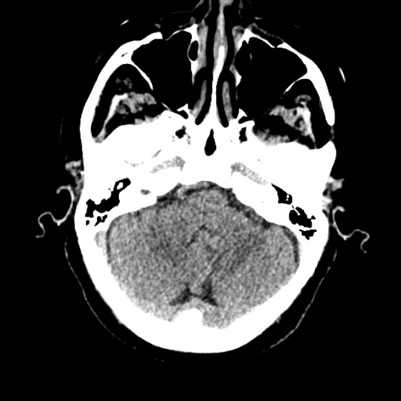 Acute middle cerebral artery territory infarct (Radiopaedia 52380-58283 Axial non-contrast 20).jpg