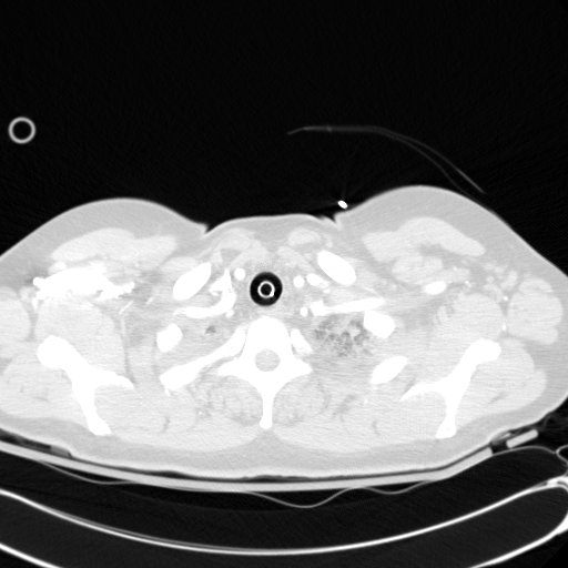 Acute myocardial infarction in CT (Radiopaedia 39947-42415 Axial lung window 7).jpg