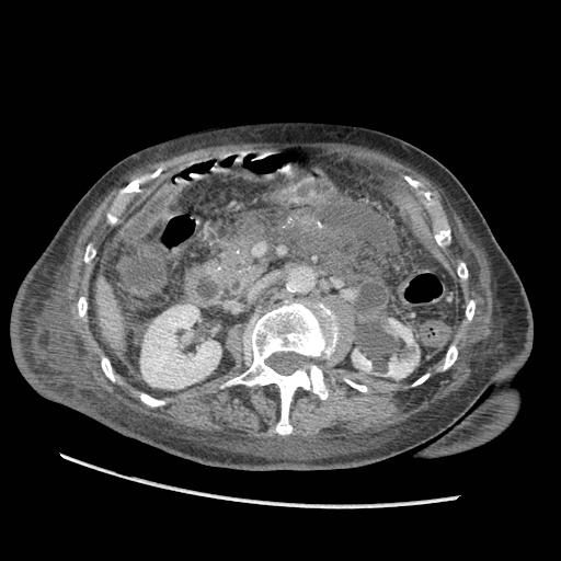 Acute on chronic pancreatitis (Radiopaedia 13233-13244 Axial C+ portal venous phase 45).jpg
