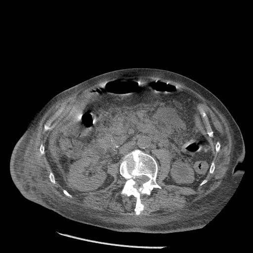 Acute on chronic pancreatitis (Radiopaedia 13233-13244 Axial non-contrast 47).jpg