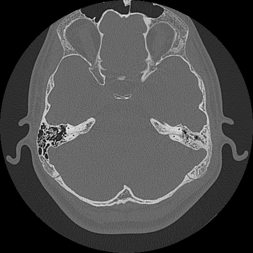 Acute otomastoiditis and Bezold abscess (Radiopaedia 88184-104786 Axial bone window 42).jpg
