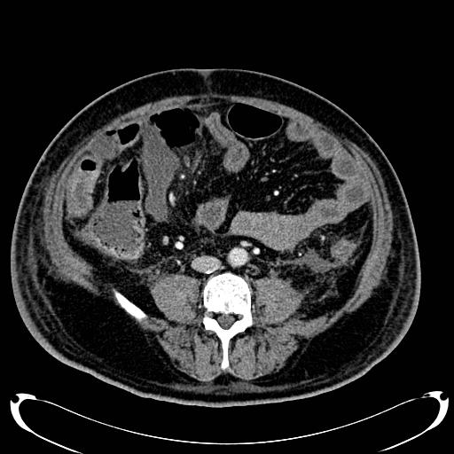 Acute pancreatic necrosis (Radiopaedia 13560-18500 Axial C+ portal venous phase 98).jpg