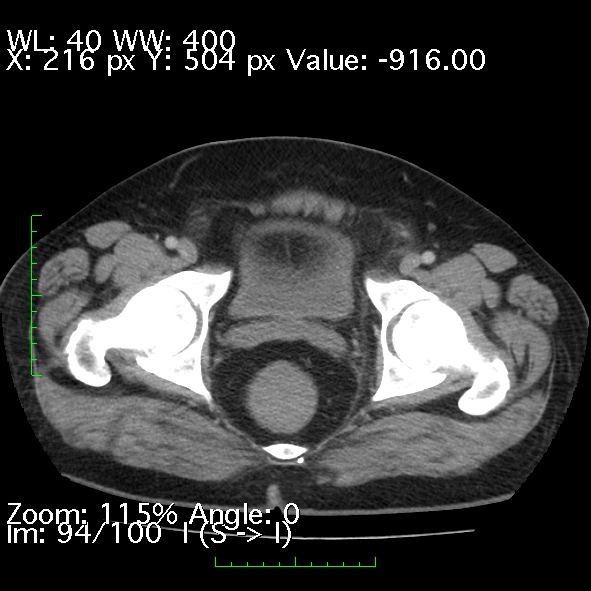 Acute pancreatitis (Radiopaedia 34043-35276 Axial C+ portal venous phase 94).jpg