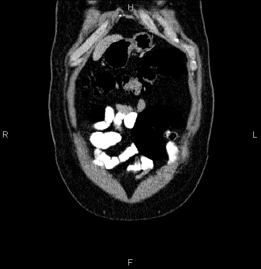 Acute pancreatitis (Radiopaedia 85390-101010 Coronal C+ portal venous phase 2).jpg