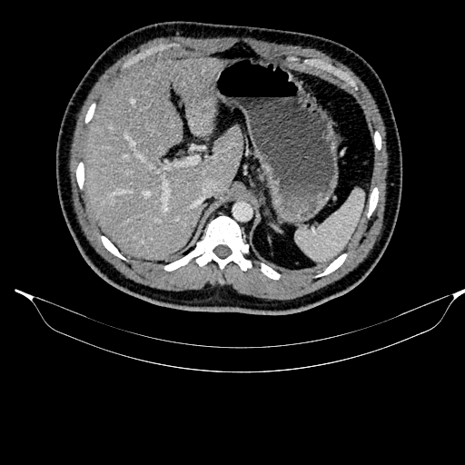 Acute pancreatitis (Radiopaedia 87428-103757 Axial C+ portal venous phase 28).jpg