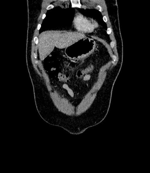 Acute pancreatitis (Radiopaedia 87428-103757 Coronal C+ portal venous phase 13).jpg