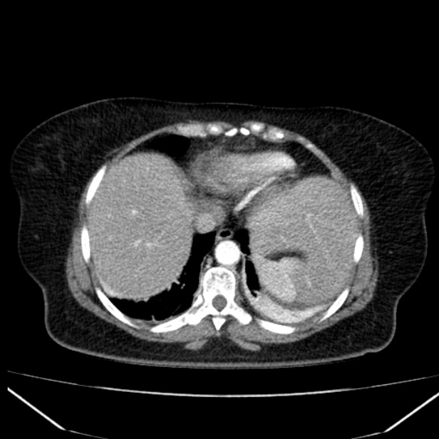 Acute pancreatitis - Balthazar C (Radiopaedia 26569-26714 Axial C+ arterial phase 10).jpg