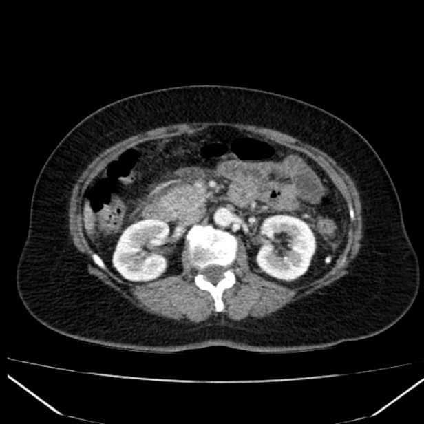 Acute pancreatitis - Balthazar C (Radiopaedia 26569-26714 Axial C+ arterial phase 39).jpg