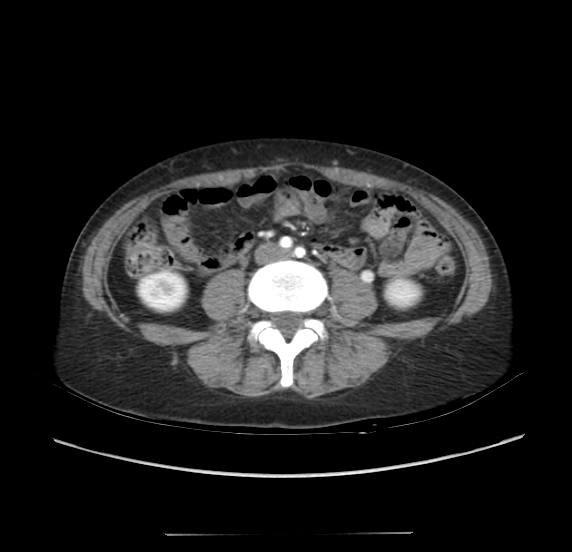File:Acute pancreatitis - Balthazar E - post ERCP (Radiopaedia 27562-27772 Axial C+ arterial phase 37).png