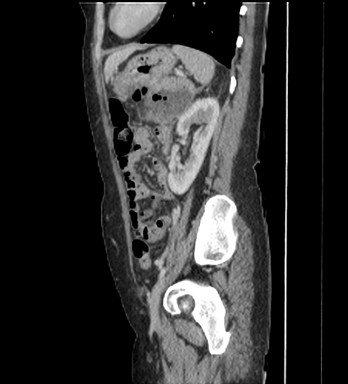 Acute pancreatitis - Balthazar E - post ERCP (Radiopaedia 27562-27772 Sagittal C+ portal venous phase 97).png