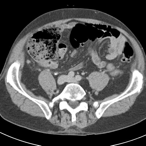 Acute pancreatitis and walled-off necrosis (Radiopaedia 29888-30403 Axial C+ delayed 58).jpg