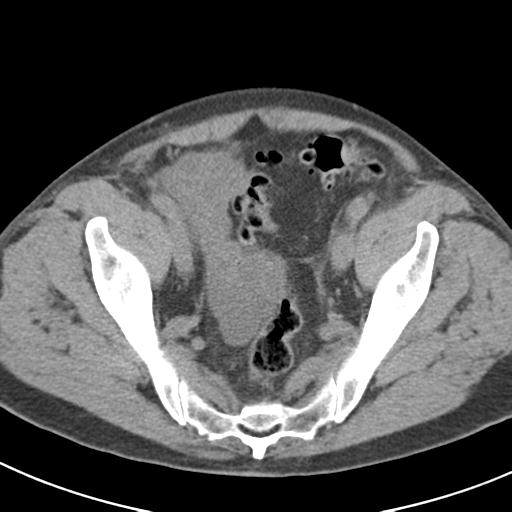 File:Acute pancreatitis and walled-off necrosis (Radiopaedia 29888-30403 Axial non-contrast 65).jpg