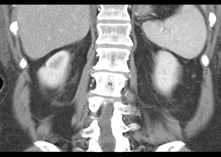 Acute pancreatitis and walled-off necrosis (Radiopaedia 29888-30403 Coronal C+ portal venous phase 43).jpg