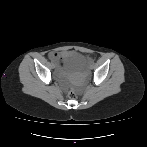 File:Acute pancreatitis secondary to stone at minor papilla and pancreatic divisum (Radiopaedia 76570-88333 Axial non-contrast 67).jpg