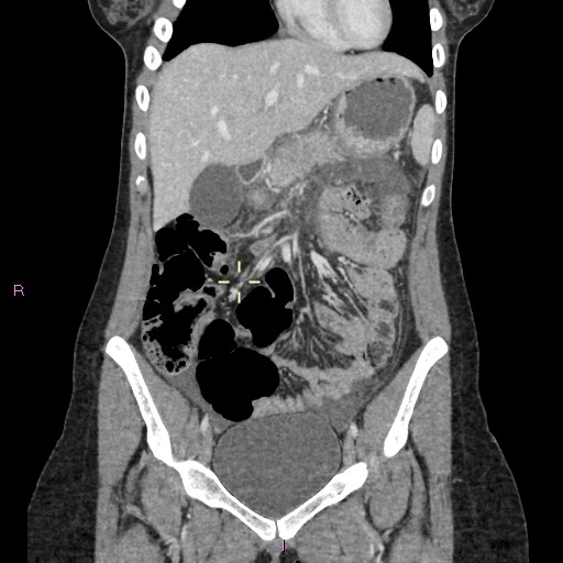 File:Acute pancreatitis secondary to stone at minor papilla and pancreatic divisum (Radiopaedia 76570-88333 Coronal C+ portal venous phase 8).jpg