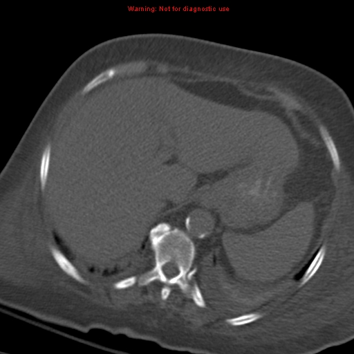 Acute pulmonary embolism (Radiopaedia 13286-13289 Axial C+ CTPA 62).jpg