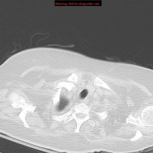 File:Acute pulmonary embolism (Radiopaedia 13286-13289 B 5).jpg
