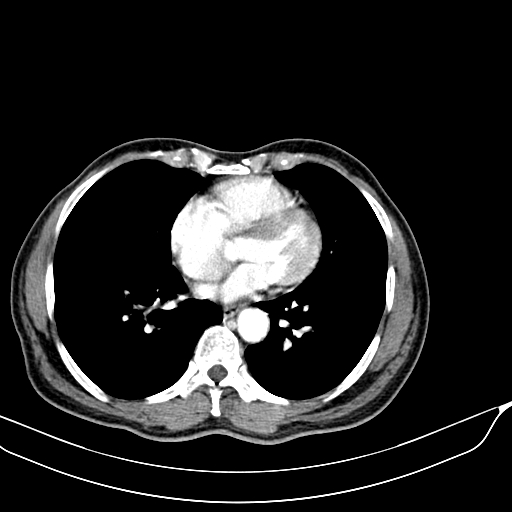 Acute pulmonary embolism (Radiopaedia 69510-79390 D 47).jpg