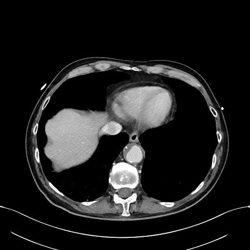 Acute renal infarction (Radiopaedia 59375-66736 Axial C+ portal venous phase 7).jpg