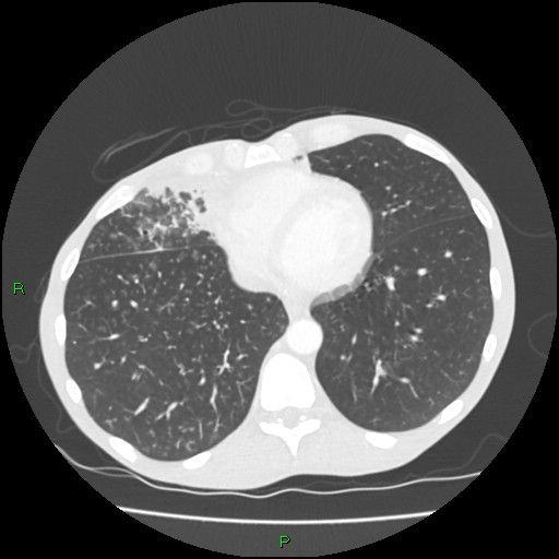 Acute right lung abscess (Radiopaedia 34806-36258 Axial lung window 136).jpg
