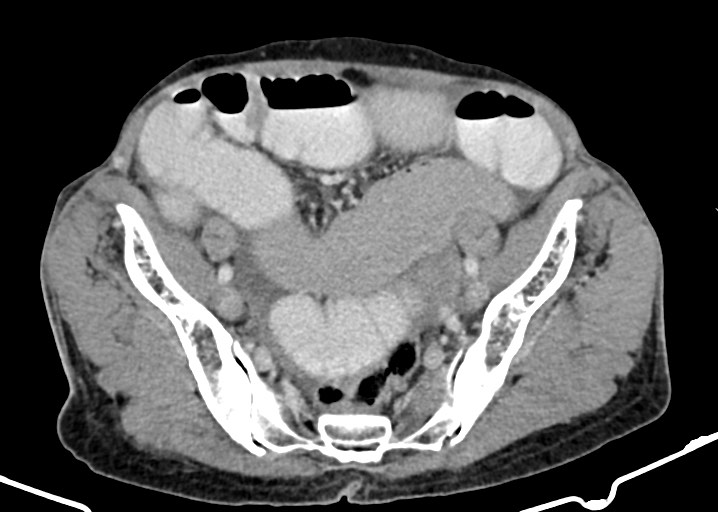 Acute small bowel (ileal) volvulus (Radiopaedia 71740-82139 Axial C+ portal venous phase 158).jpg