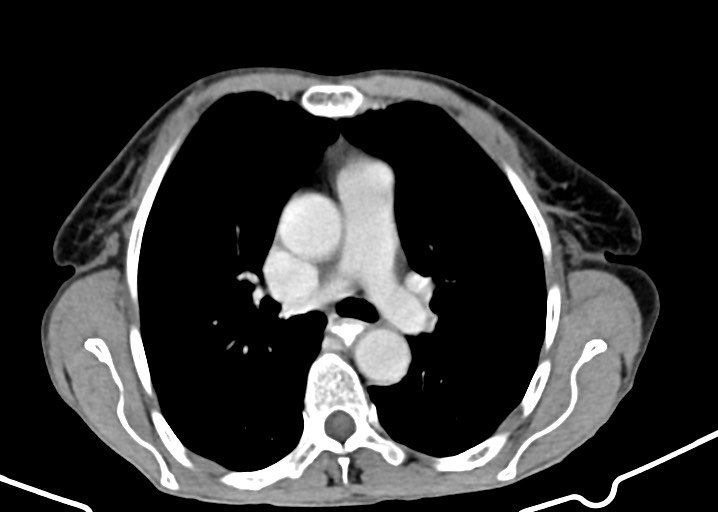 Acute small bowel (ileal) volvulus (Radiopaedia 71740-82139 Axial C+ portal venous phase 3).jpg