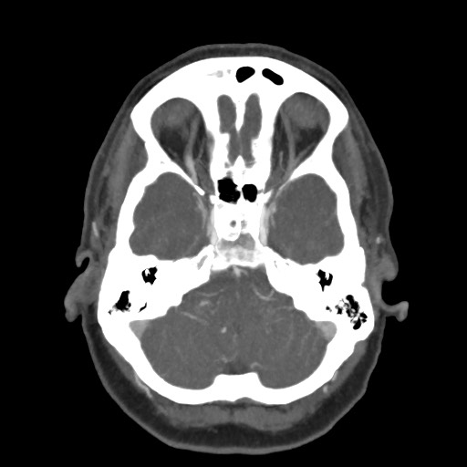 Acute subarachnoid hemorrhage and accessory anterior cerebral artery (Radiopaedia 69231-79009 D 18).jpg
