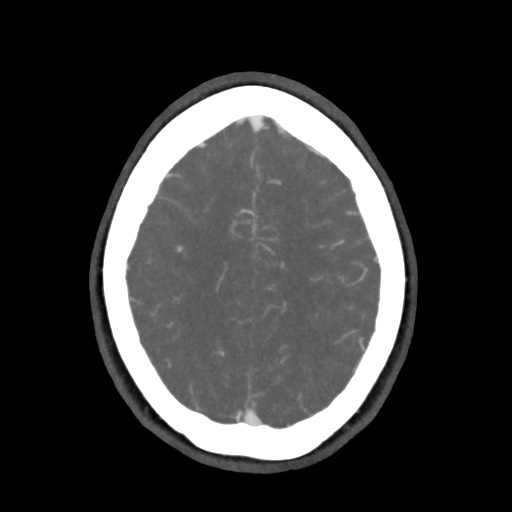 Acute subarachnoid hemorrhage and accessory anterior cerebral artery (Radiopaedia 69231-79009 D 54).jpg