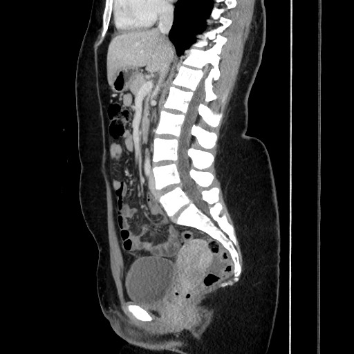 File:Acute uncomplicated appendicitis (Radiopaedia 73704-84499 Sagittal C+ portal venous phase 112).jpg