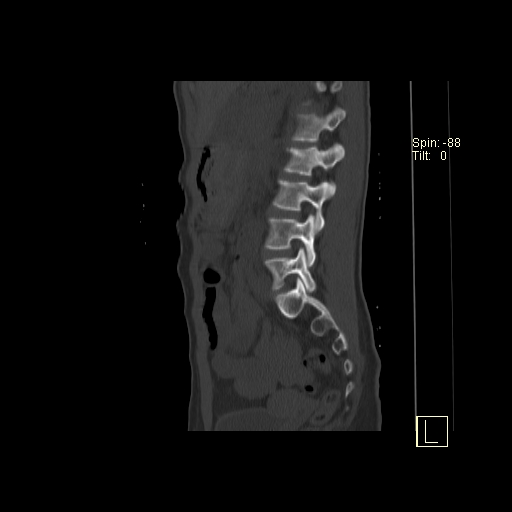 File:Acute vertebral compression fracture (Radiopaedia 63832-72559 Sagittal bone window 3).jpg