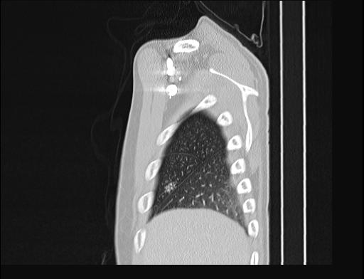 Addison disease (Radiopaedia 49318-54412 Sagittal lung window 57).jpg