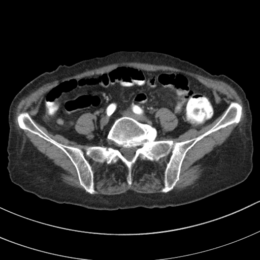 Adenocarcinoma of cecum (Radiopaedia 59222-66549 Axial C+ arterial phase 104).jpg